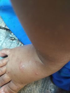 SCABIES-SKIN INFECTION IN KIDS