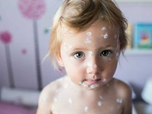 Chicken Pox in Pediatric age