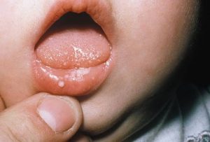 fungal infections in kids